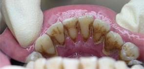 Dentální hygiena - Před